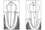 Mobilidade de dentes naturais: quando extrair?