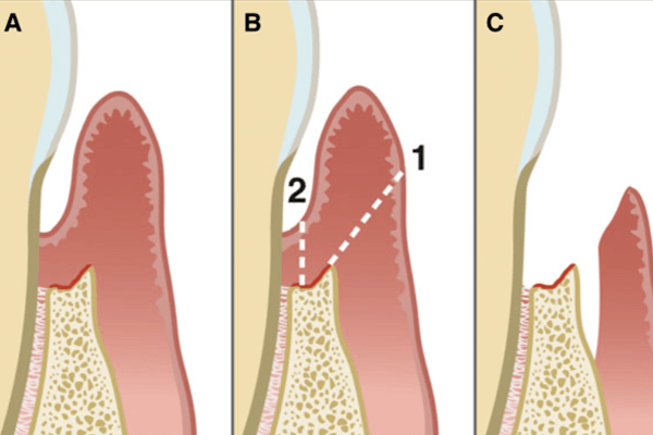 tratamento da doença periodontal