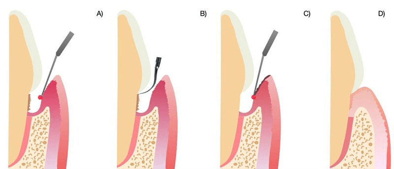 laser periodontal