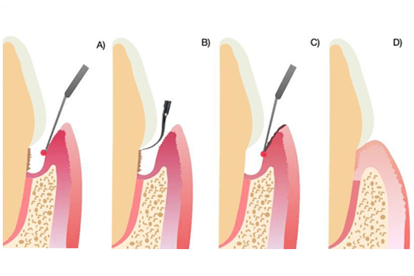 Laser na terapia não-cirúrgica periodontal