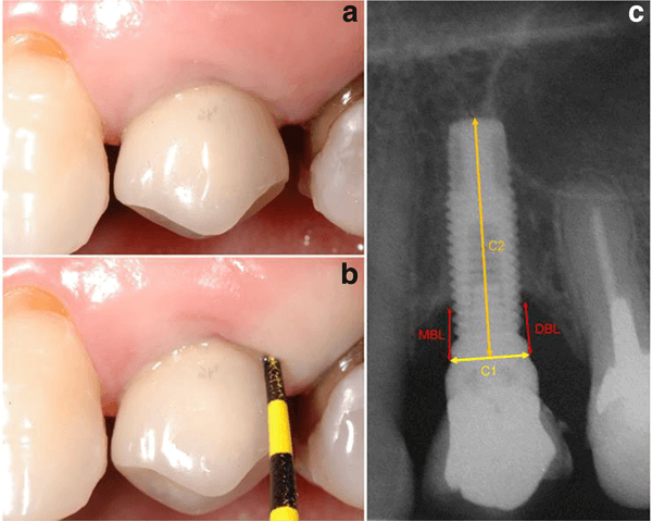 peri-implantite na região posterior de maxila