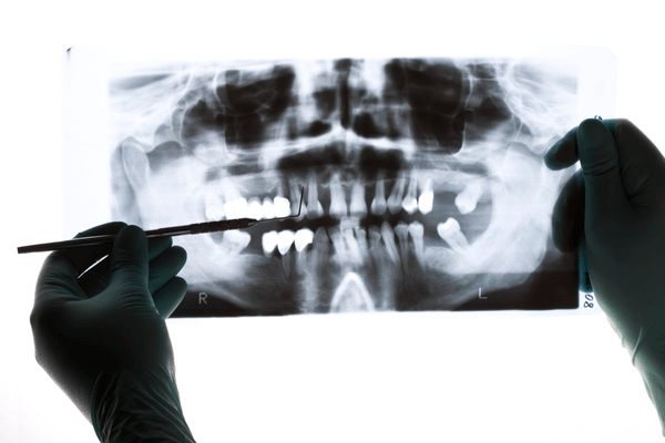 periodontite peri-implantite radiografia