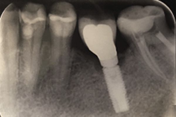 fratura recorrente de pilares e implantes