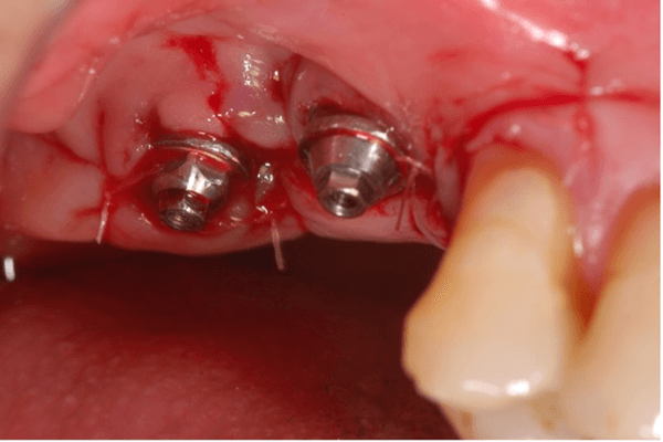 terapia cirúrgica da peri-implantite