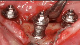 implantes incisivos