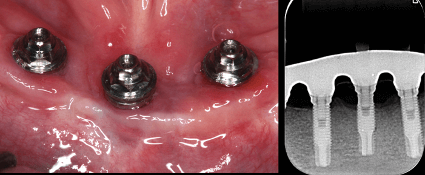 implantes incisivos