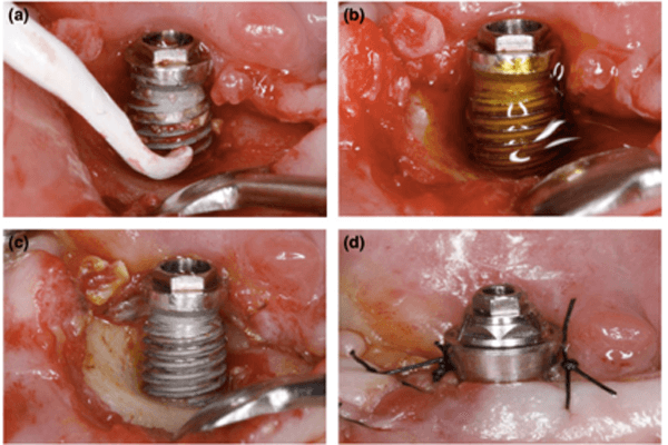 Descontaminação química de implantes com peri-implantite