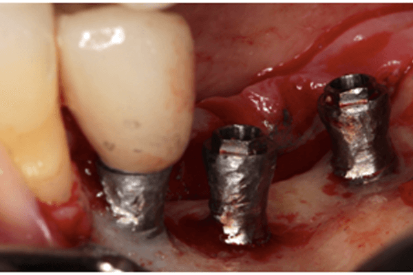 A implantoplastia deixa os implantes mais frágeis?