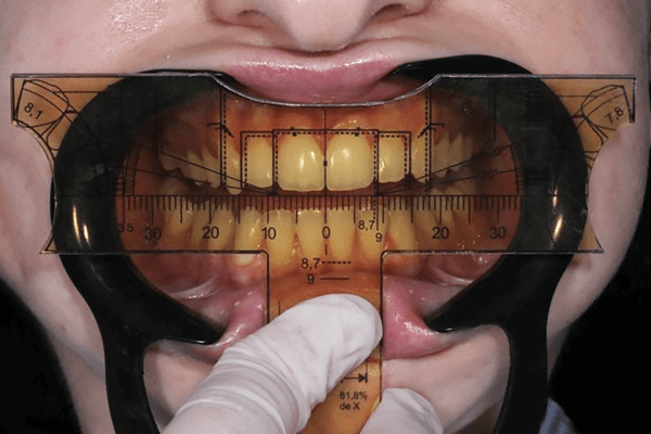 Indusbello lança produto para análise de proporção dentária