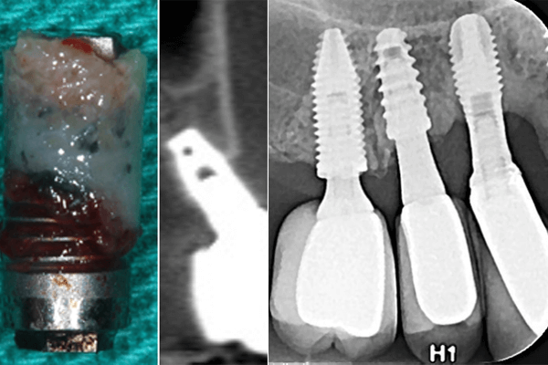 Como fica o osso ao redor de implantes com peri-implantite?