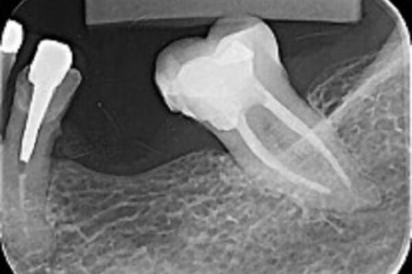 Correção de dentes inclinados vizinhos a implantes