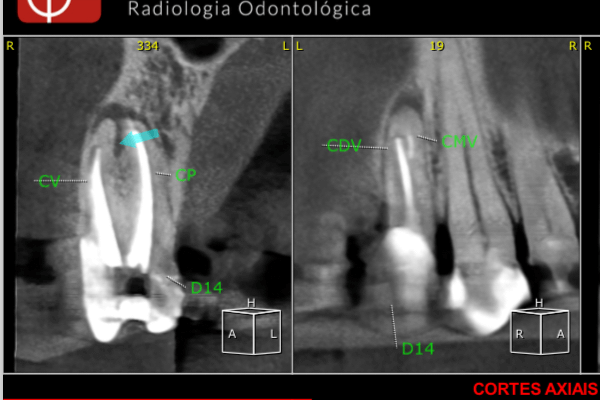 Retratamento endodôntico, apicectomia ou implante?