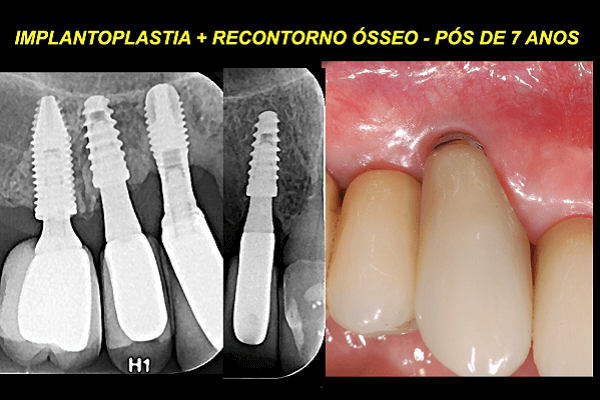 Recontorno ósseo no tratamento da peri-implantite