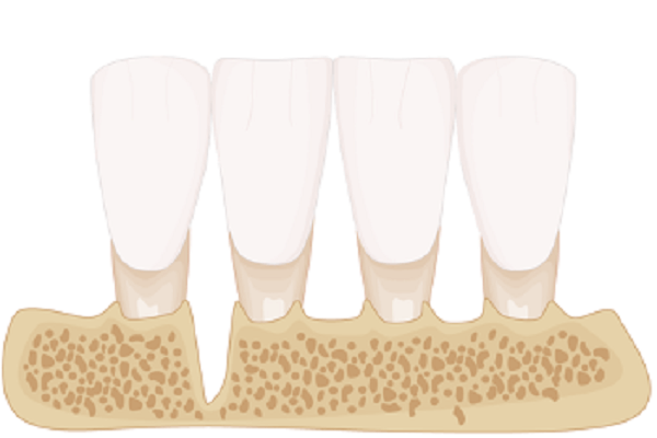 Defeitos periodontais verticais: tratar ou substituir por implantes?